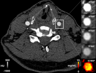 S. Boccalini, S. Si-Mohamed,R. Dessouky et al. “Feasibility of human vascular imaging of the neck with a large field-of-view spectral photon-counting CT system”, 2021